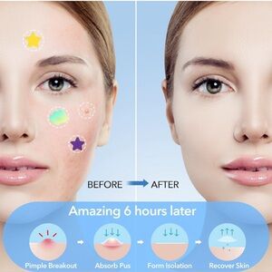 Pimple Patches for Face, Hydrocolloid Acne with Tea Tree Oil,  232pcs
